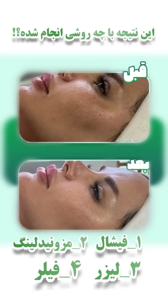 نمونه مزوتراپی کلینیک زیبایی لانا (دکتر رسولی) زنجان