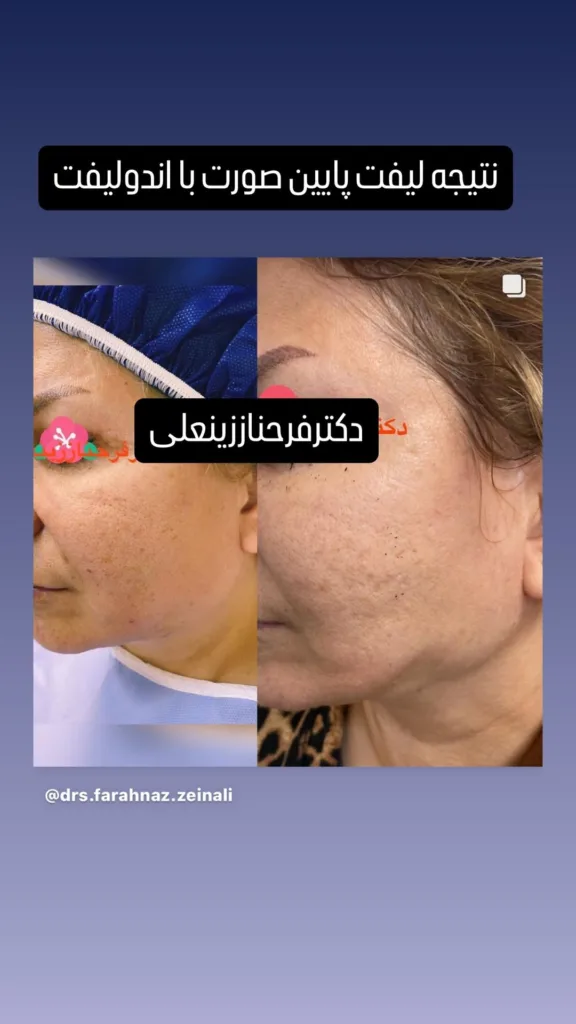 نمونه اندولیفت کلینیک تخصصی پوست و مو پارس (دکتر زینعلی) زنجان