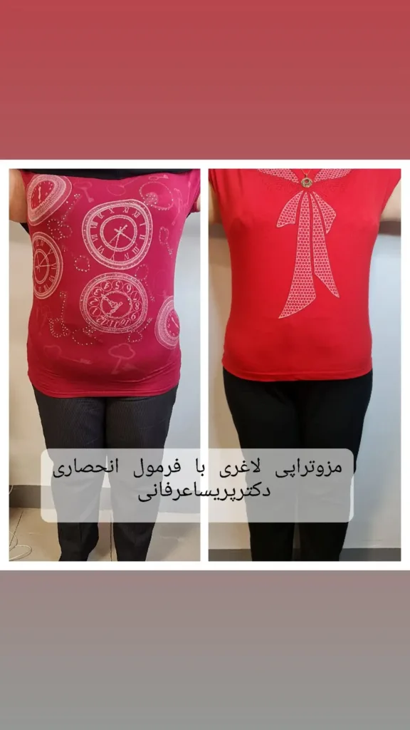 نمونه لاغری موضعی مطب دکتر پریسا عرفانی همدان