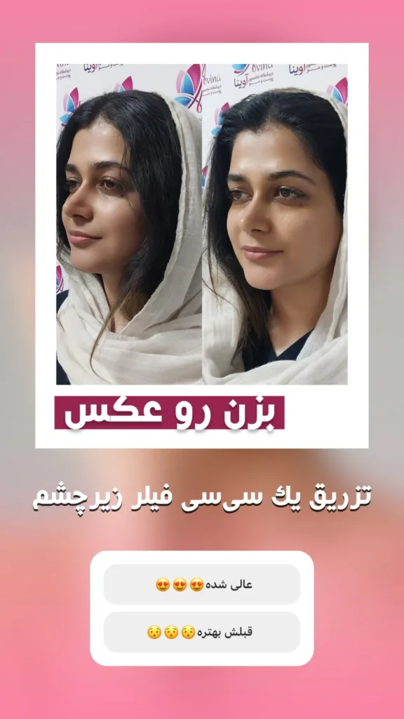 نمونه فیلر زیر چشم کلینیک پوست و مو آوینا کرج
