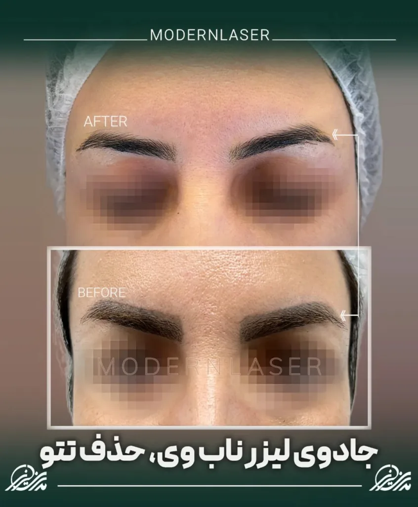 نمونه کار کلینیک مدرن لیزر اصفهان