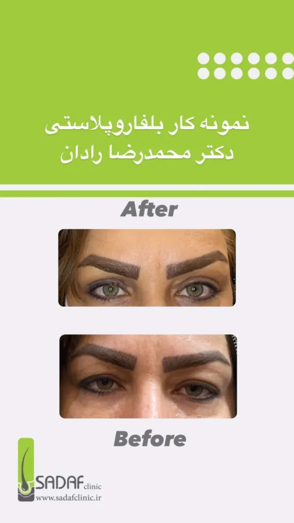 نمونه بلفاروپلاستی کلینیک زیبایی صدف اصفهان