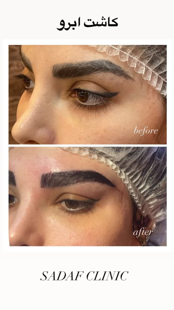 نمونه کاشت ابرو کلینیک زیبایی صدف اصفهان