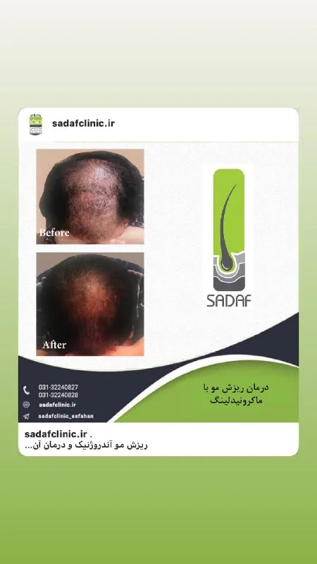 نمونه ماکرونیدلینگ کلینیک زیبایی صدف اصفهان