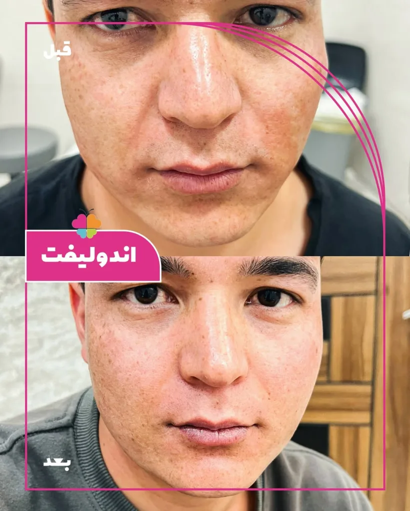 نمونه اندولیفت کلینیک تخصصی پوست و مو سینایار اصفهان