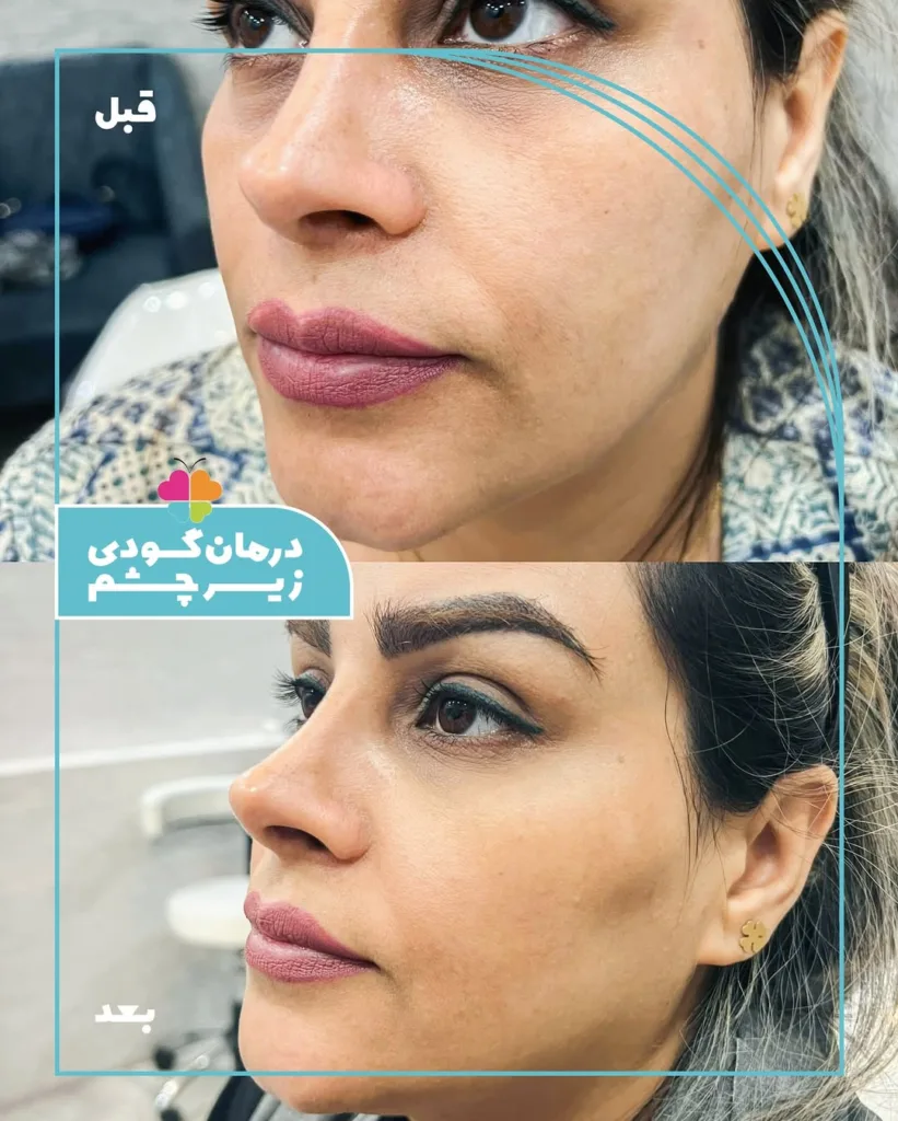 نمونه درمان گودی کلینیک تخصصی پوست و مو سینایار اصفهان