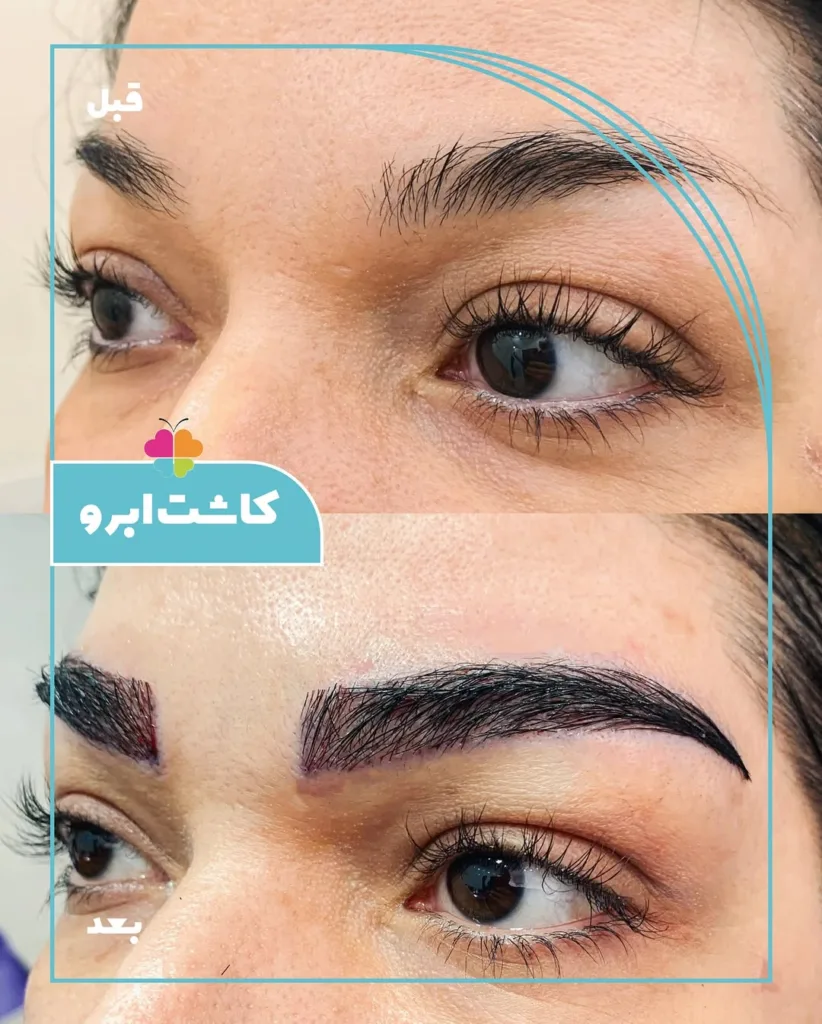 نمونه کاشت ابرو کلینیک تخصصی پوست و مو سینایار اصفهان