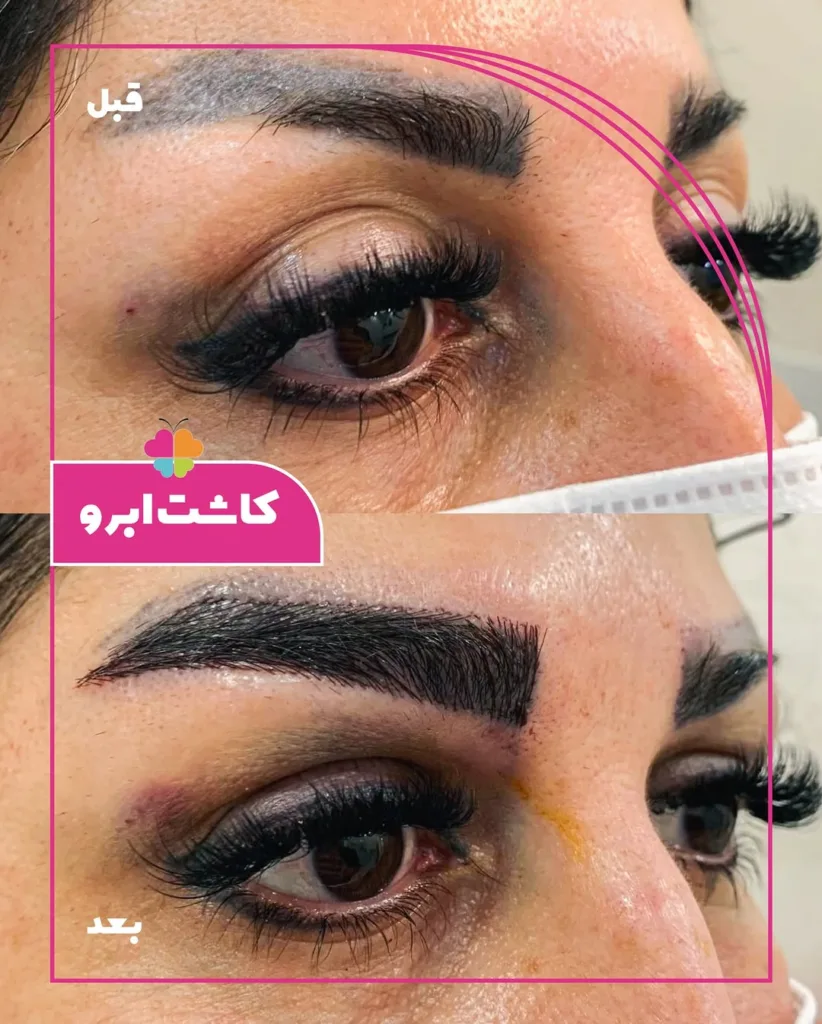 نمونه کاشت ابرو کلینیک تخصصی پوست و مو سینایار اصفهان
